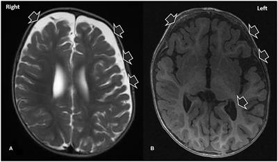 Pediatric Anti-N-methyl-D-aspartate Receptor Encephalitis Mimicking Glutaric Aciduria Type 1: A Case Report